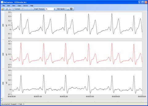 ECG ScreenShot